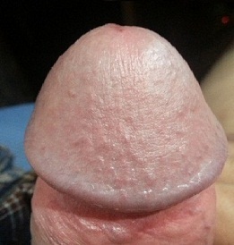 Photo of the enlarged penis glans