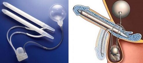 penile augmentation surgery