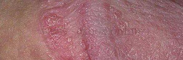Dry skin and penis head ulcers after using baking soda