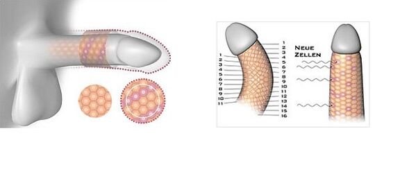 Result of penis enlargement surgery